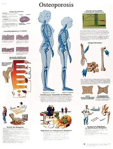 Fabrication Enterprises - From: 12-4615L To: 12-4615P - Anatomical Chart osteoporosis, laminated