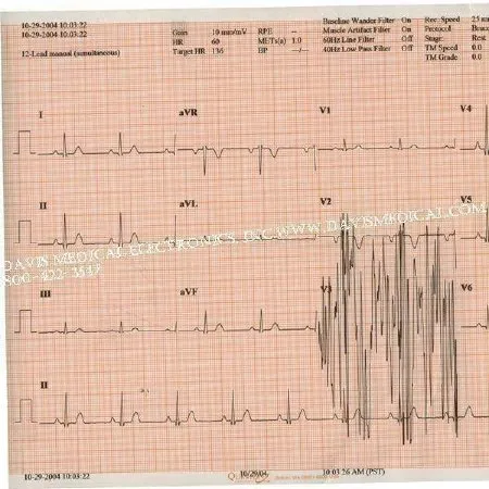 S & W Healthcare - Medi-Trace - 18416-002 - Diagnostic Recording Paper Medi-trace Thermal Paper 216 X 280 Mm Z-fold Red Grid