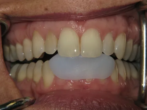 All Dental Prodx - 143020 - Temp Tabs-True