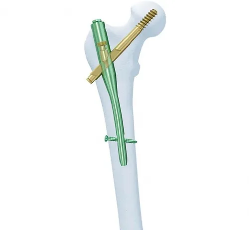 Synthes - 456.420s - Synthes 11mm/130° Ti Cannulated Trochanteric Fixation Nail 400mm/Right - Sterile